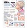 Understanding Alzheimer?s Disease Anatomical Chart, 2nd Edition